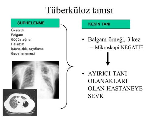 Tüberküloz Tanısı Belirtileri ve Tedavisi