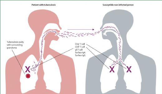 Verem Tüberküloz Belirtileri ve Tedavisi