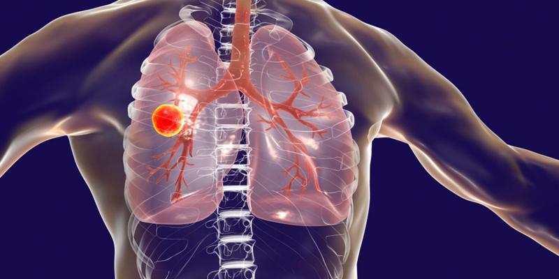 Akciğer Tüberkülozu Belirtileri ve Tedavisi