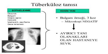 Tüberküloz Tanısı, Belirtileri ve Tedavisi Tüberküloz Tanısı