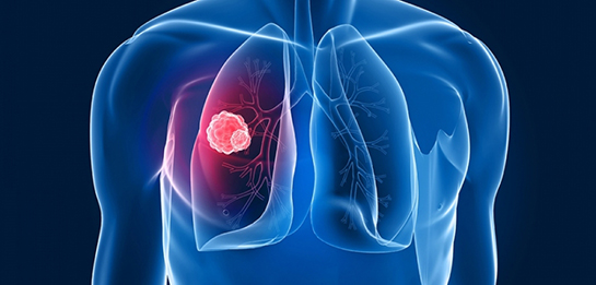 Tüberküloz Belirtileri ve Tedavisi