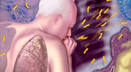 Verem Belirtileri ve Tedavisi